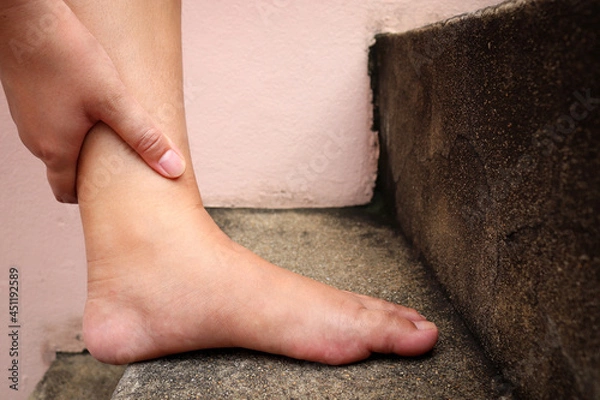 Obraz asian woman can't go upstairs. Due to muscle weakness, pain, and tingling at the nerve endings of the leg. Concept of Guillain Barre syndrome and a possible side effect of the COVID-19 vaccine.