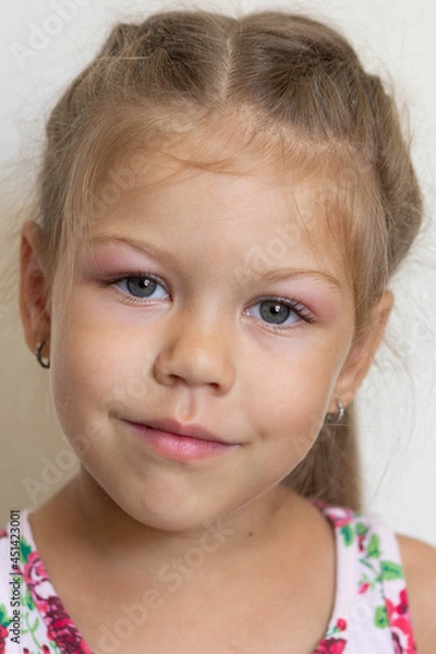Fototapeta Portrait of caucasian little girl of five years old with swelling eyes because of allergy, conjunctevitis and adenoids