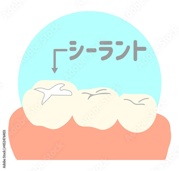 Obraz 歯のシーラント