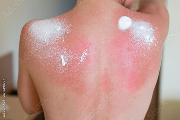 Obraz Woman's back skin hurt from sun burn. Protective aerosol is applied to sunburn on woman's back.