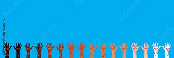 Obraz Horizontal banner. 8 pairs of hands raised up. Hands of different races and skin colors. Palms up. Painful rash covers skin. Vector illustration of skin diseases and manifestations of illness signs.