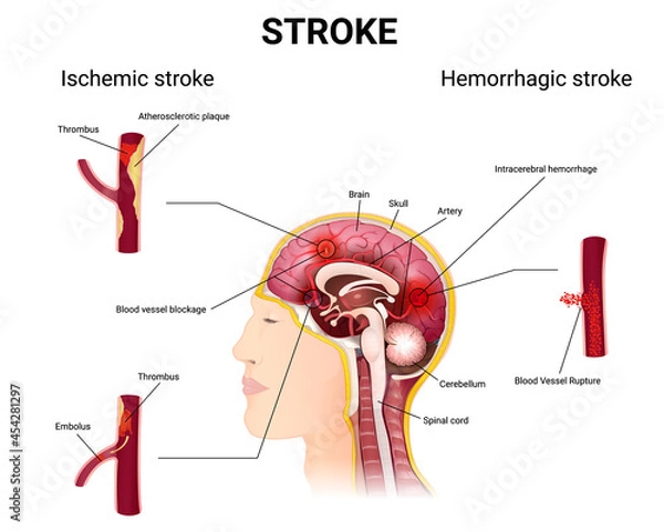 Fototapeta causes of stroke and the development of the disease