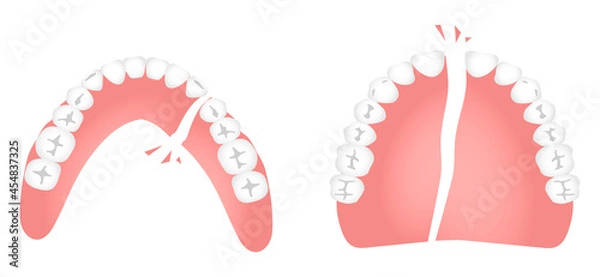 Obraz 割れた入れ歯（上下）