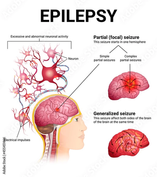 Fototapeta types of epileptic seizures, brain and neurons
