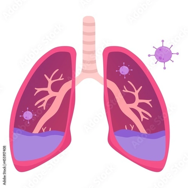 Fototapeta Vector illustration of a lung that has been infected with bacteria, suitable for advertising health and education products