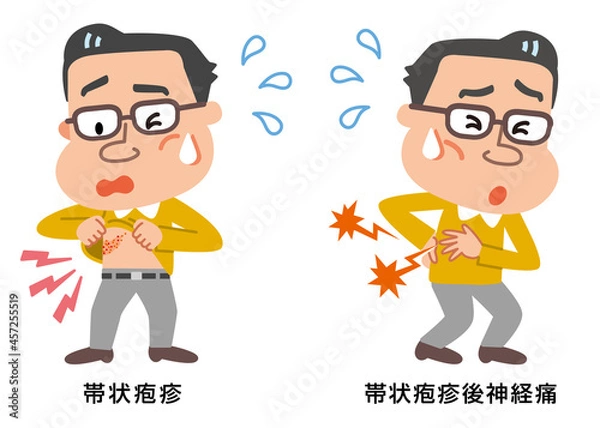Obraz 帯状疱疹と帯状疱疹後神経痛の中年男性のイラスト