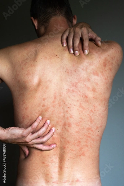 Fototapeta Allergy concept. Man suffers from skin irritation isolated on gray background. Itchy back with rash