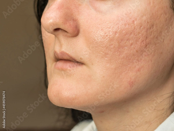 Fototapeta Woman with problematic skin and acne scars. Pigmentation on face woman. 