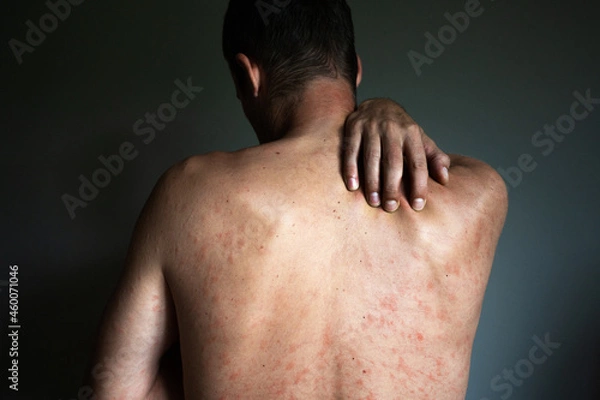 Fototapeta Back of man with chickenpox, itching and burning. Medical complications after illness
