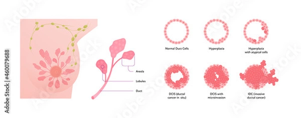 Obraz WebHuman breast cancer anatomy diagram. Vector flat medical illustration. Front view. Stages disease and tumor cells isolated on white background. Design for healthcare, science, education, oncology.