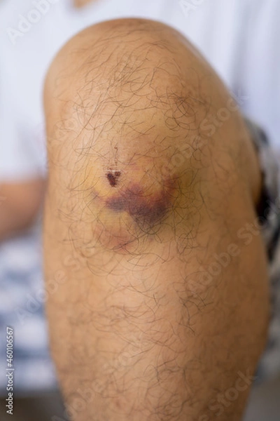 Obraz Bruises and scabs on the knee caused by extreme sports.