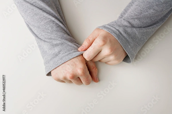 Fototapeta Person hiding hands with red spots on skin with grey sleeves. Allergic reaction, side effect from taking medicines, wrong diet.