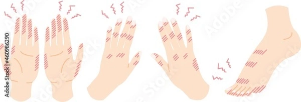 Fototapeta 手荒れ 手足のしもやけ のイラスト