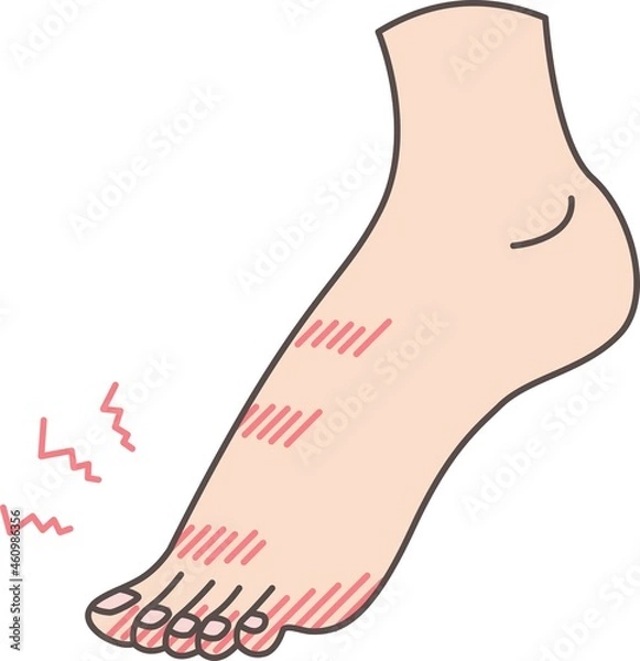 Fototapeta 足のしもやけのイラスト