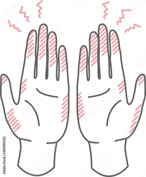 Obraz 手荒れ しもやけ のイラスト