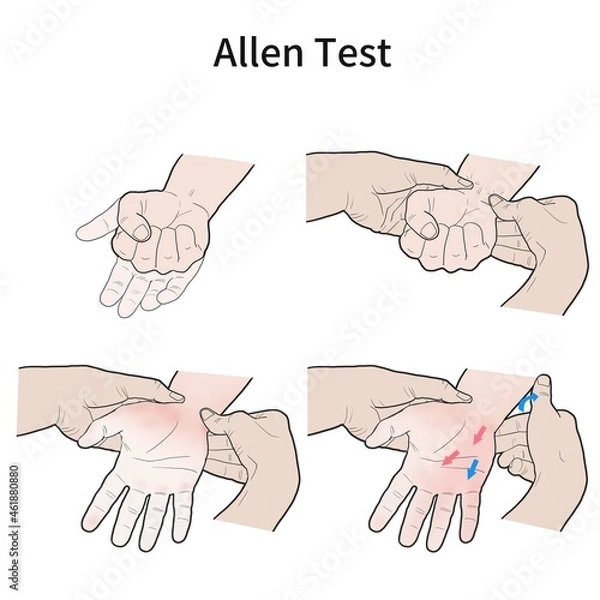Obraz 알렌테스트 수족냉증 검사