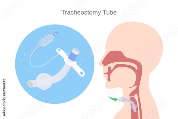 Fototapeta Tracheostomy tube is a device to help a patient who can not breathe with nose and mouth. Illustration about Tracheostomy is surgical to inserted a siliconized tube into the trachea to help breath.