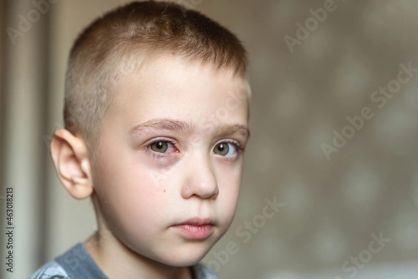 Obraz Boy swollen red eye allergy. Portrait of Caucasian upset child looking at the camera. Inflammation of the eye. Face of allergic person. Copy space. Allergy
