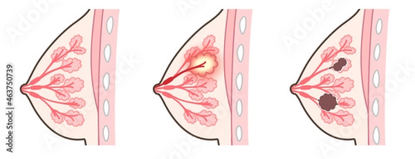 Fototapeta 乳腺炎のイラスト