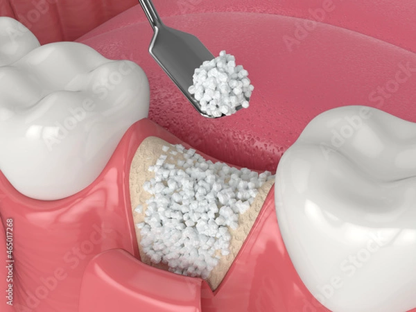 Fototapeta 3D render of dental bone grafting with bone biomaterial application