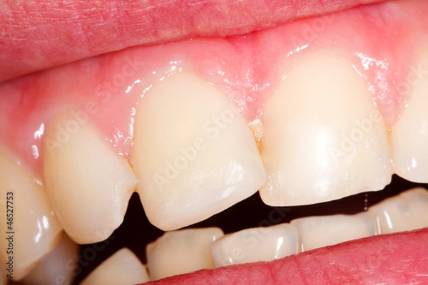 Fototapeta An fractured incisor filled with composite resin.