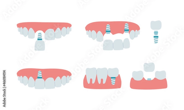 Obraz Jaw with healthy teeth and dental implant, dental bridge. Installation process and the scheme of the implant of a molar tooth, an incisor. Set of isolated vector illustrations in flat style