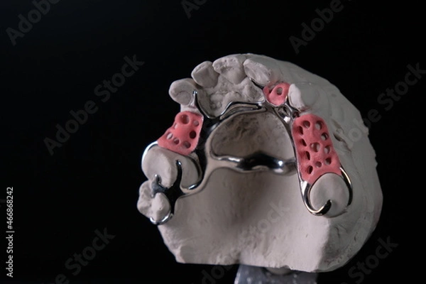 Obraz Removable clasp prosthesis of the upper jaw