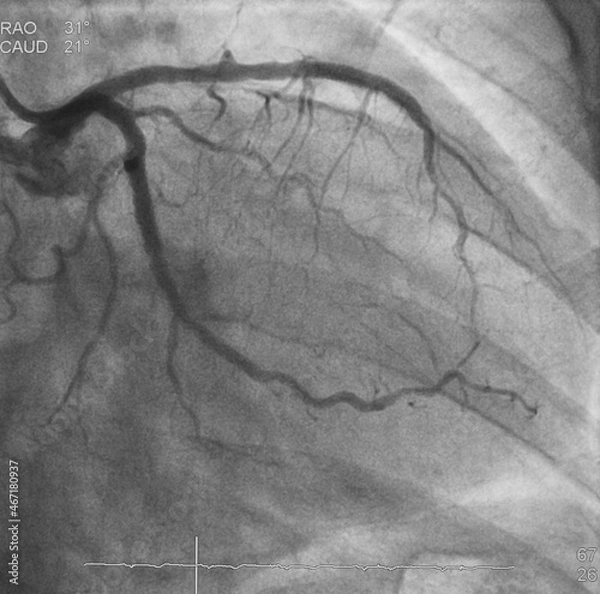Fototapeta Coronary angiogram (CAG) was performed successful percutaneous coronary intervention (PCI) at left circumflex artery (LCx) with drug eluting stent (DES).