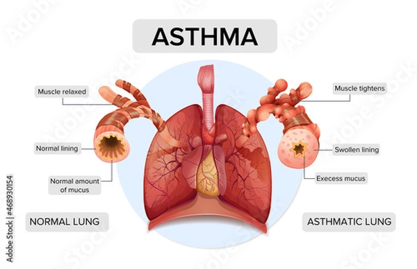 Obraz Asthma. Lung structure