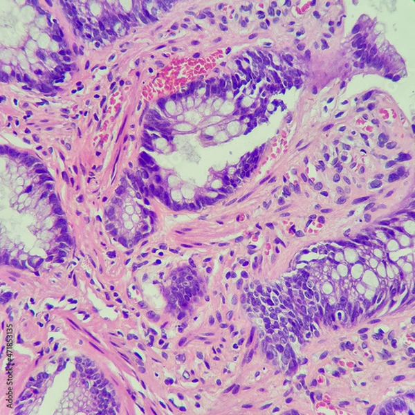Fototapeta Camera photo of colonic mucosa, showing ulcer with muscular fibers in lamina propria. Solitary rectal ulcer syndrome is suggestive. Magnification 400x, photograph through a microscope
