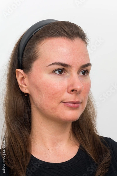 Obraz post-acne on the patient's face. Remission of papulopustular rosacea