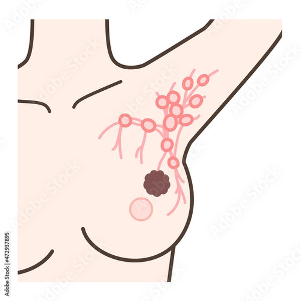 Fototapeta センチネルリンパ節生検の解説イラスト