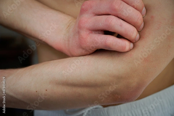 Fototapeta Scratching inside of the elbow closeup