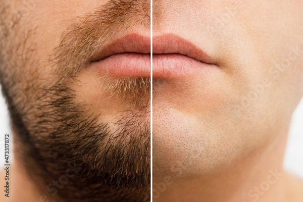 Fototapeta Close up photo of a man's face before and after shaving. a young man with a beard. Comparison of a man's face with a beard and without a beard. use of aftershave cream.
