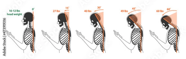 Obraz Computer neck syndrome, tech neck, text neck. Changes in pressure on the cervical spine with different head positions. Flat vector illustration is isolated on white background