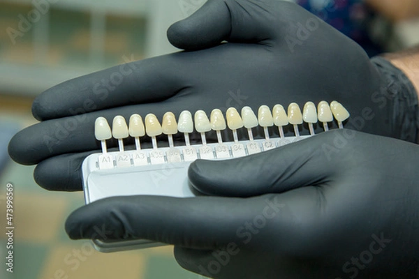 Obraz Veneers for teeth