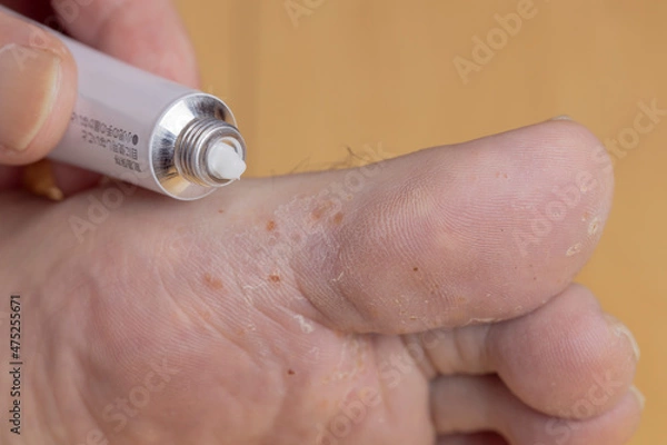 Obraz 足裏の水虫と塗り薬