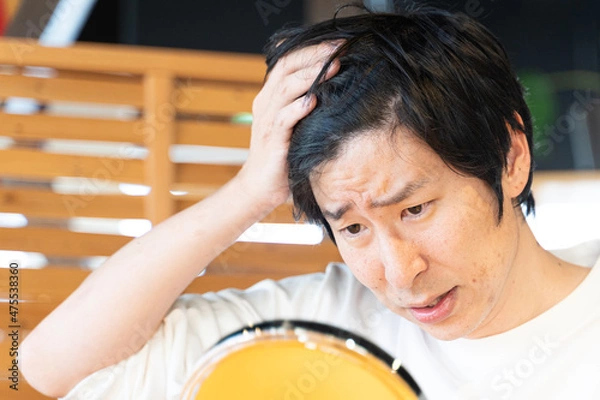 Obraz 若い男性が生え際のハゲを気にする