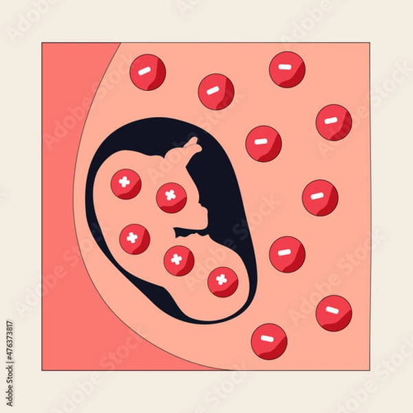 Obraz Hemolytic disease of the fetus and newborn Infographic. Vector illustration of Rh disease, isoimmunization, Rh D