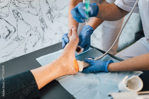 Fototapeta Close-up of the hands of a Chiropodist injecting contrast for an ultrasound into a patient's foot.