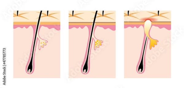 Fototapeta にきびのしくみ