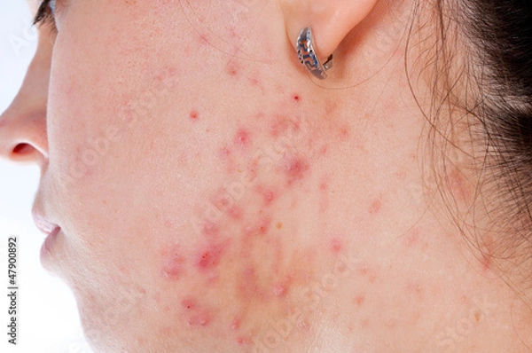 Obraz Problems with skin