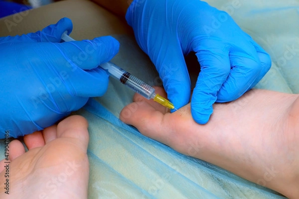Fototapeta Surgeon in gloves is making injection of local anesthesia on boy's foot before laser removing of wart. Remove papillomavirus verruca on leg. One day surgery concept. Sore and wound before operation.