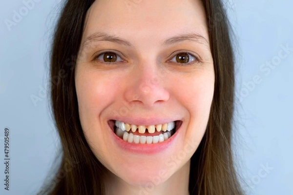 Fototapeta Portrait of woman with yellow bad teeth is smiling and looking at camera. Teeth sharpened by a dentist before installing crowns and ceramic veneers. Dentistry treatment, prosthetics of teeth concept.