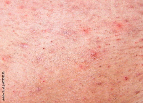 Obraz Human skin with acne
