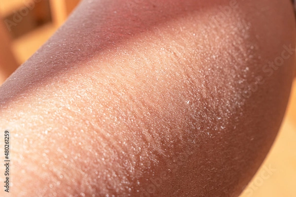 Fototapeta Concept of extremely dry and dehydrated skin of the body. Problem skin diagnosed with xerosi or dermatitis. Close up of chapped arms and legs. Selective focus of a itchy skin.