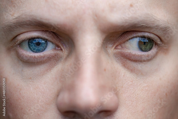 Fototapeta full face photo of a man with strabismus and blindness of one eye. visual disability