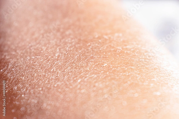 Fototapeta Concept of extremely dry and dehydrated skin of the body. Problematic skin diagnosed with xerosi or dermatitis. Close up of chapped arms and legs. Selective focus of a itchy skin.