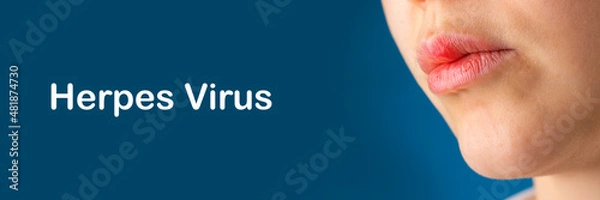 Fototapeta Lower part part of unrecognizable woman face with Red bubbles of virus herpes on her lips.