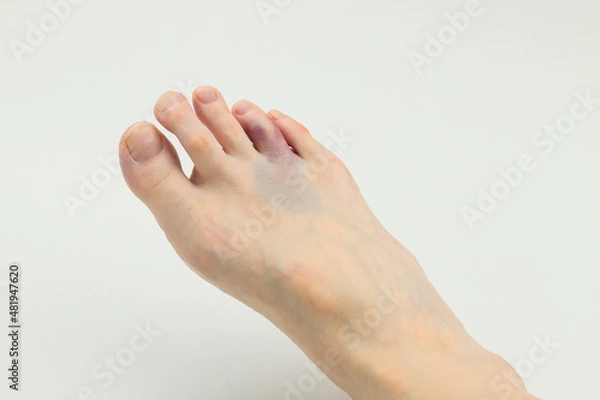 Fototapeta 右足薬指の強打による打撲傷